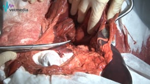 Pancreatectomía parcial