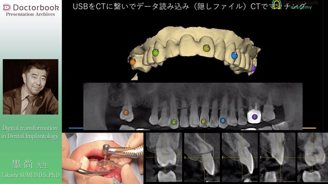 #2 上顎前歯部 デジタル設計と実際のインプラント埋入手術