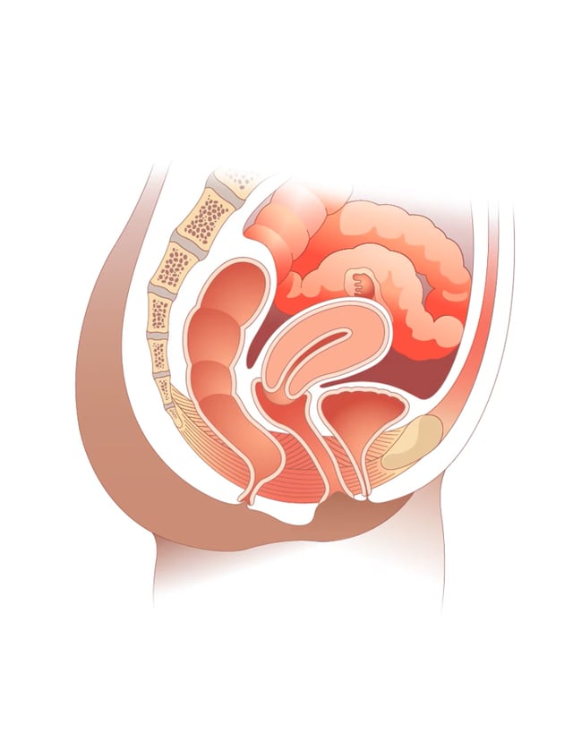 Teen Girls Squirt - Understanding Pelvic Organ Prolapse | ACOG