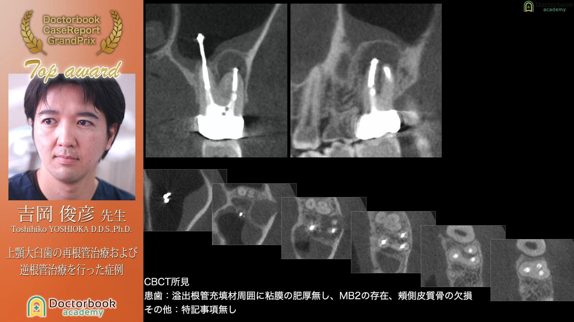 【第3回ケースレポートGP　最優秀発表賞】吉岡 俊彦先生「上顎大臼歯の再根管治療および逆根管治療を行った症例」