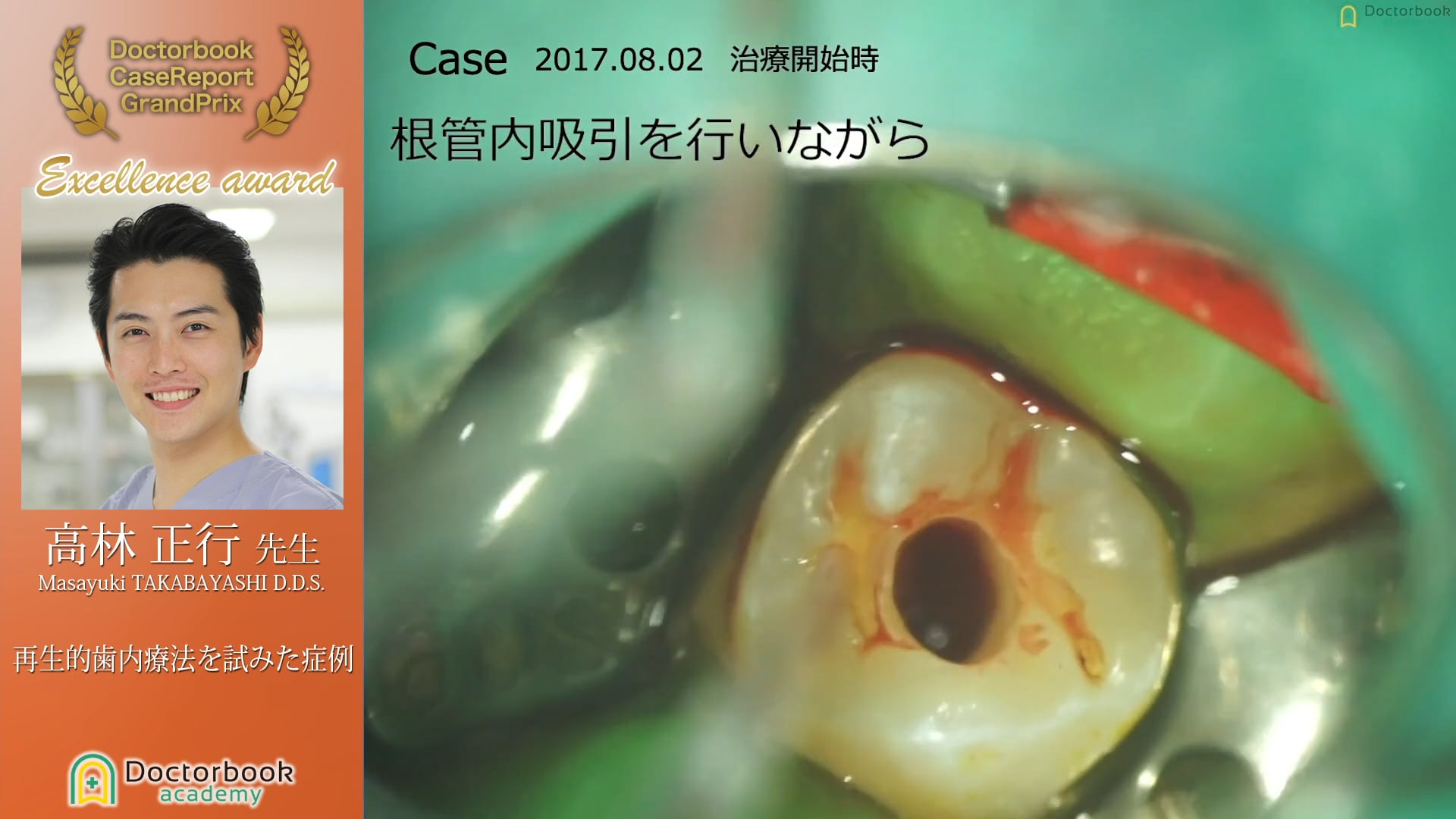 【第3回ケースレポートGP　優秀発表賞】高林 正行先生「再生的歯内療法を試みた症例」