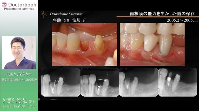 抜歯か、保存か？ 重度歯周病患者への治療戦略