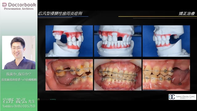 #3  広汎型侵襲性歯周炎症例とまとめ
