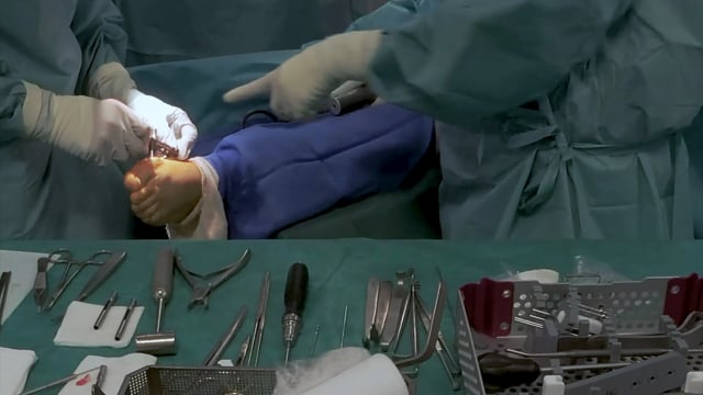 Centrolock® surgical movie by Dr. Michel Maestro