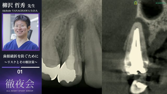 歯根破折を防ぐために 〜リスクとその解決策〜