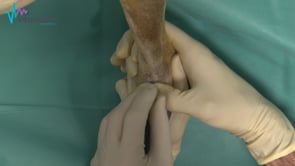 Artrocentesis del tarso por punción dorsal