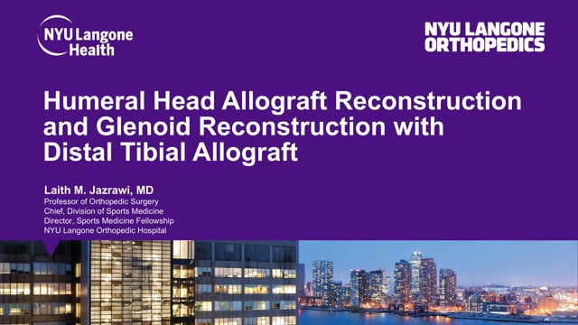Humeral Head Allograft Reconstruction and Glenoid Reconstruction with Distal Tibial Allograft