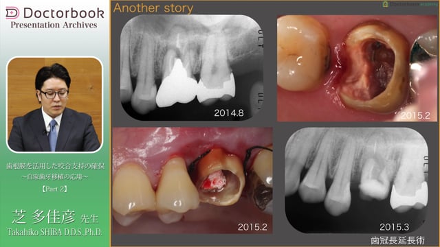 #2 上顎洞挙上術を応用した歯牙移植