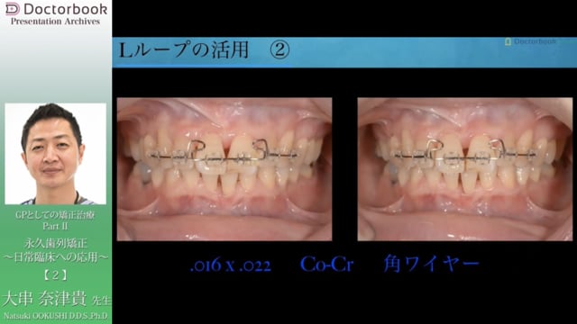 #2 Lループの活用とアップライト