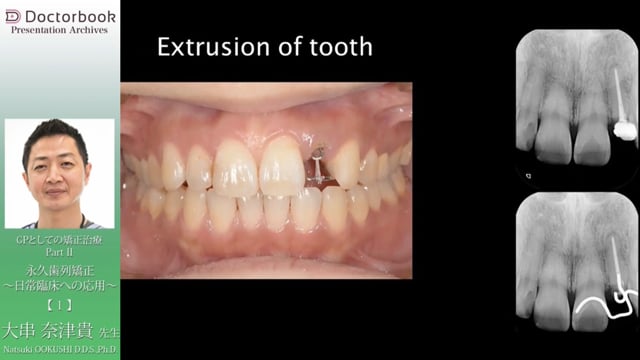 「永久歯列矯正 〜日常臨床への応用〜」GPとしての矯正治療 PartⅡ