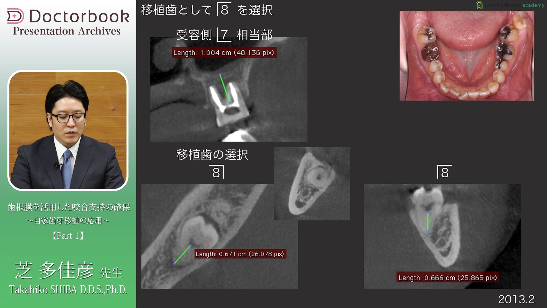 #1 自家歯牙移植の成功に関わる因子