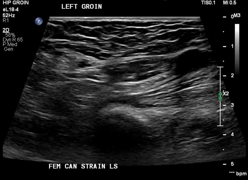 Hernia pathology ULTRASOUNDPAEDIA