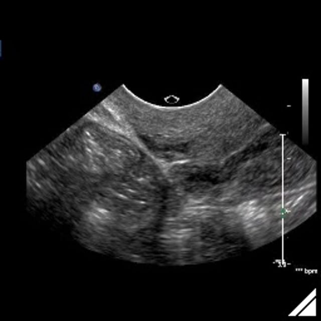 Uterus pathology ULTRASOUNDPAEDIA