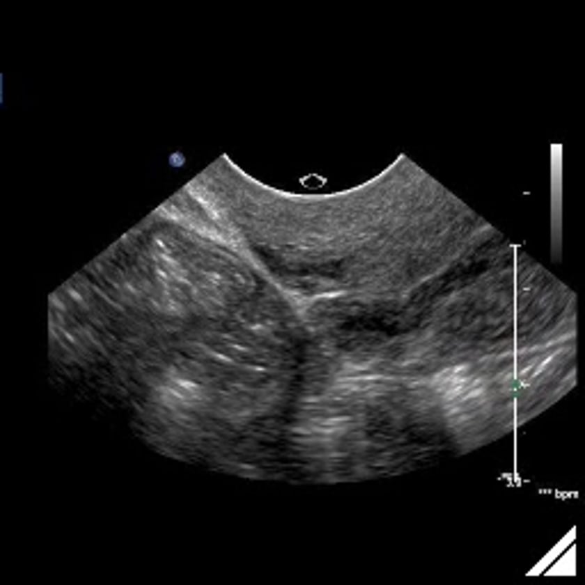 Uterus pathology – ULTRASOUNDPAEDIA