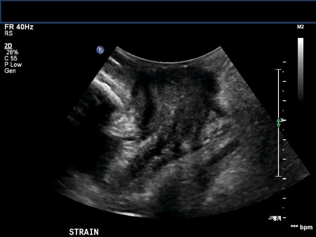 Uterus pathology – ULTRASOUNDPAEDIA