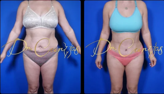 necesito una abdominoplastia? on Vimeo