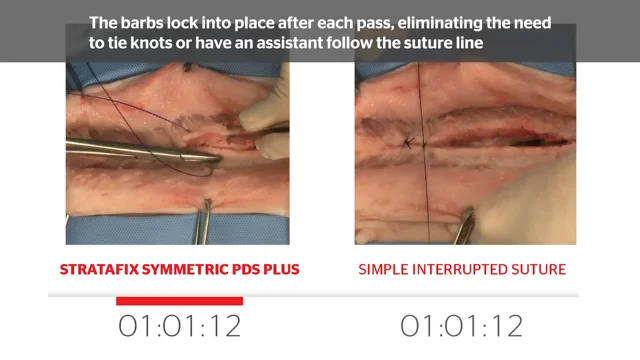 STRATAFIX Symmetric PDS Plus Alternate Initiation Suturing Technique
