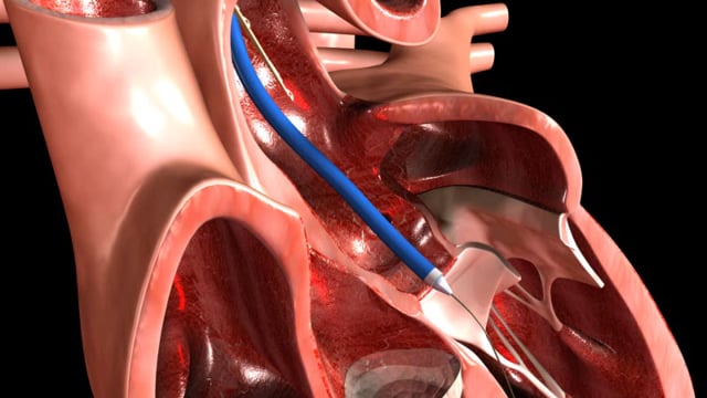 Open Zoomed Related Entry valve-medical.wmv