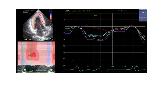 How can I perform STE in severe hypertrophy?