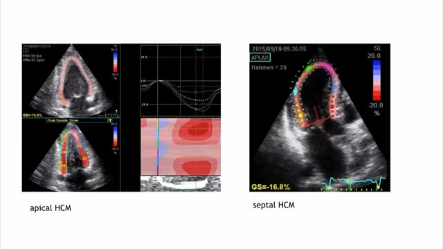 Why is regional strain so important in HCMP?