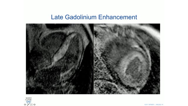 Case: The importance of speckle tracking echocardiography in amyloidosis