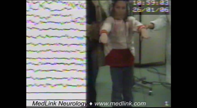 Eyelid myoclonia and absence seizures in a 7-year-old girl (video-EEG)