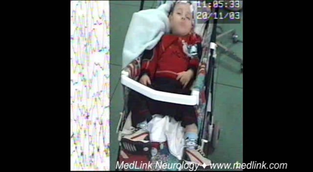 Early-onset eyelid myoclonia and absences in a 17.5-month-old boy (1) (video-EEG)