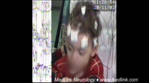 Early-onset eyelid myoclonia and absences in a 17.5-month-old boy (2) (video-EEG)