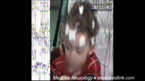 Eyelid myoclonia with and without absences | MedLink Neurology