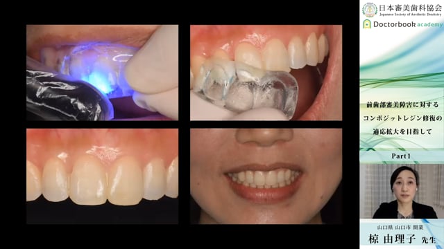 【日本審美歯科協会 WEB講演会】前歯部審美障害に対するコンポジットレジン修復の適応拡大を目指して