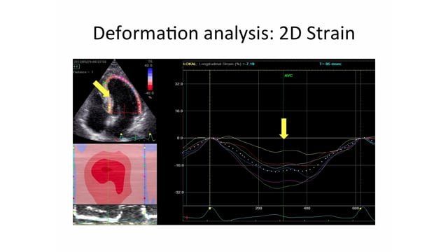 GLS in patients with myocardial fibrosis