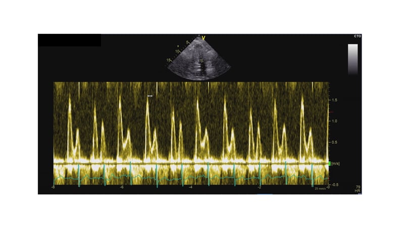 Case: STE in HFpPF patient