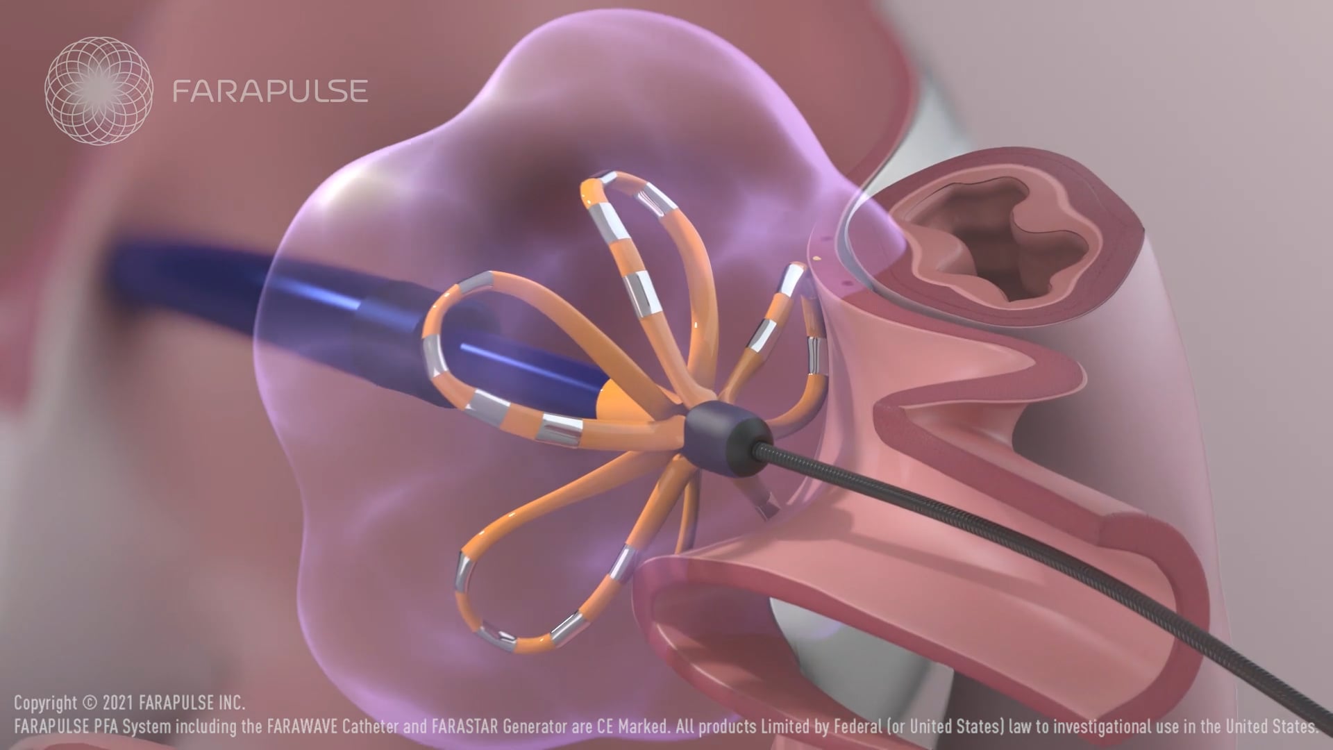 Farawave Ablation Procedure 2021 on Vimeo