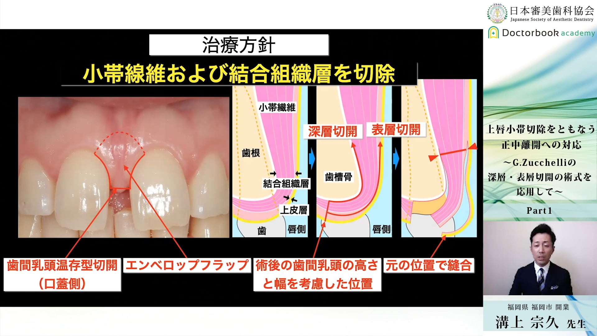 クーポン対象外】　チェアサイド・テクニック編　前歯部審美修復　健康/医学