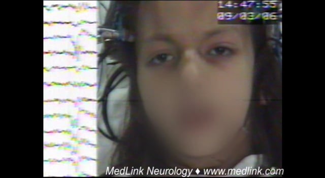 Eyelid myoclonia and absence seizures in a 9.5-year-old girl (video-EEG)