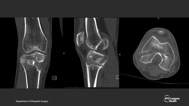 Revision Multiligament Knee Reconstruction with Coronal and Sagital Plane Malalignment Correction