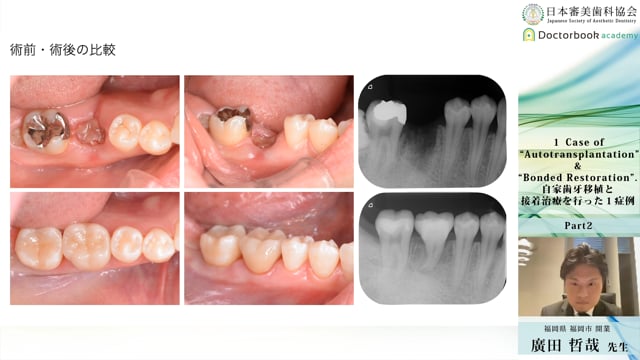 #2 移植歯の固定