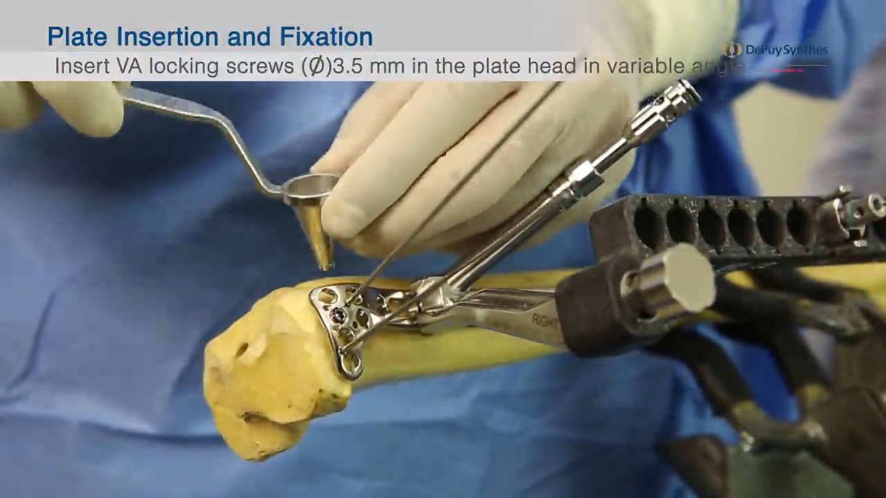 depuysynthesvalcpproximaltibialplatefixationtechnique on Vimeo