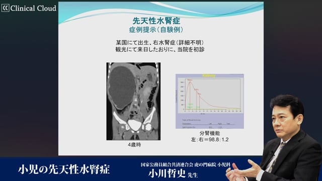 小児の先天性水腎症 -Part2-