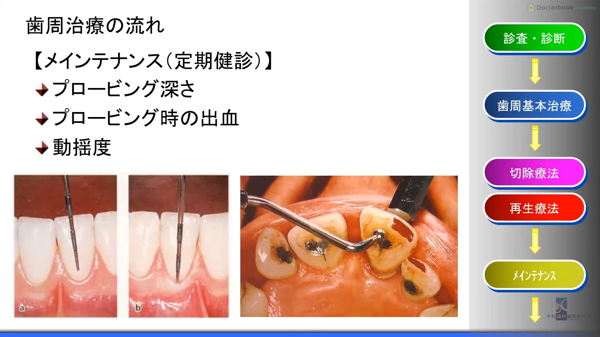 #2 根尖側移動全層弁歯肉剥離術