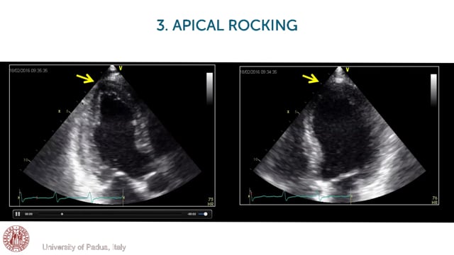 What is apical rocking?