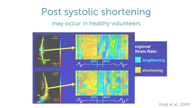 What is post systolic shortening?