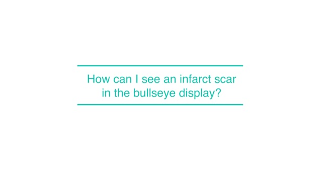 How can I see an infarct scar in the bullseye display?