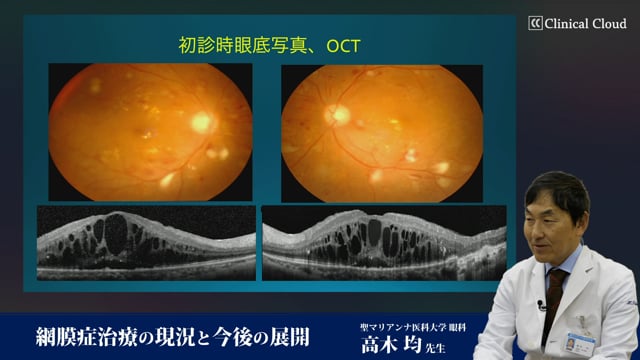 網膜症治療の現況と今後の展開