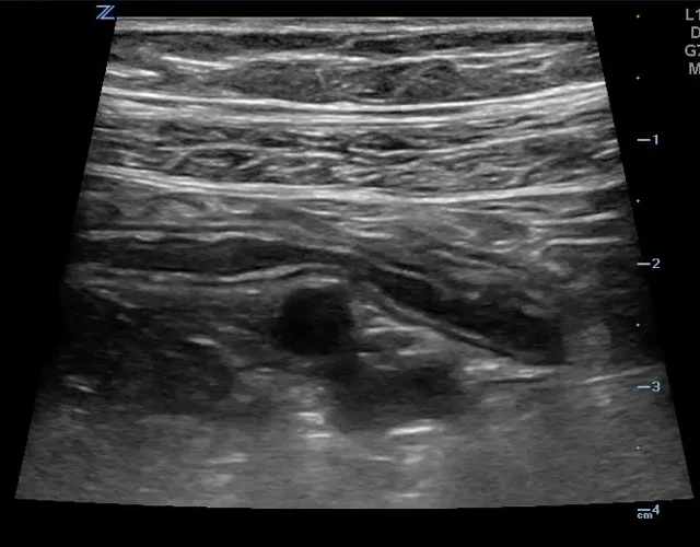 Normal Appendix Ultrasound