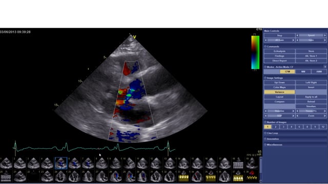 How to assess a patient with aortic regurgitation