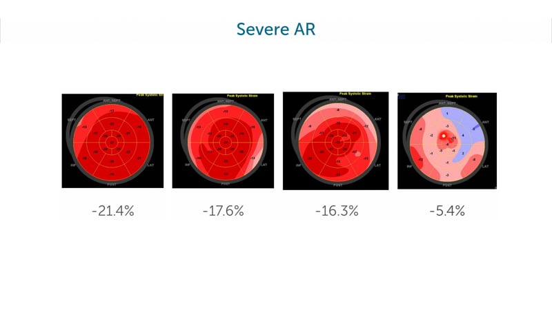 Should strain be an indicator for aortic valve surgery?