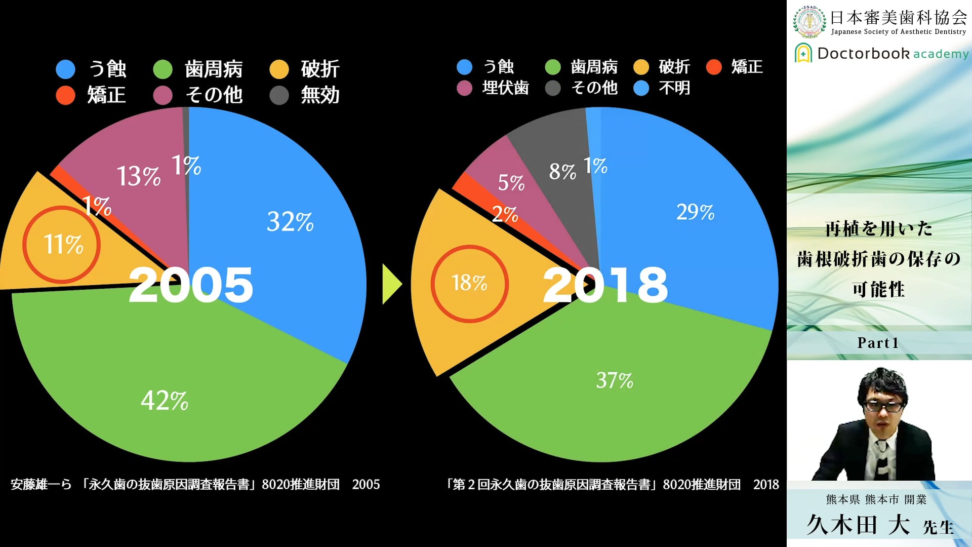 #1 歯根破折の保存方法