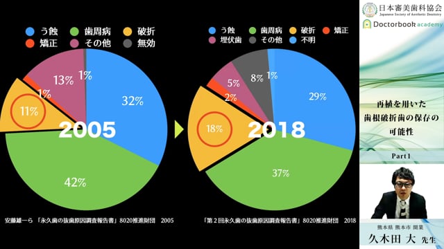 【日本審美歯科協会 WEB講演会】再植を用いた歯根破折歯の保存の可能性