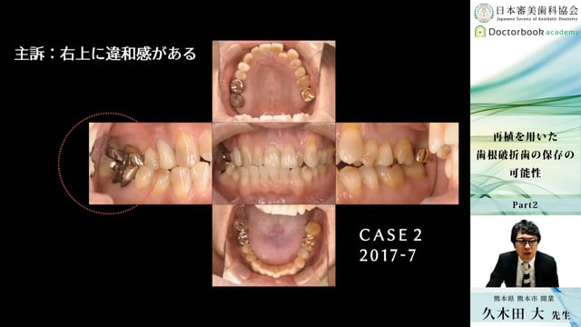 #2 残存歯根膜が少ないケース